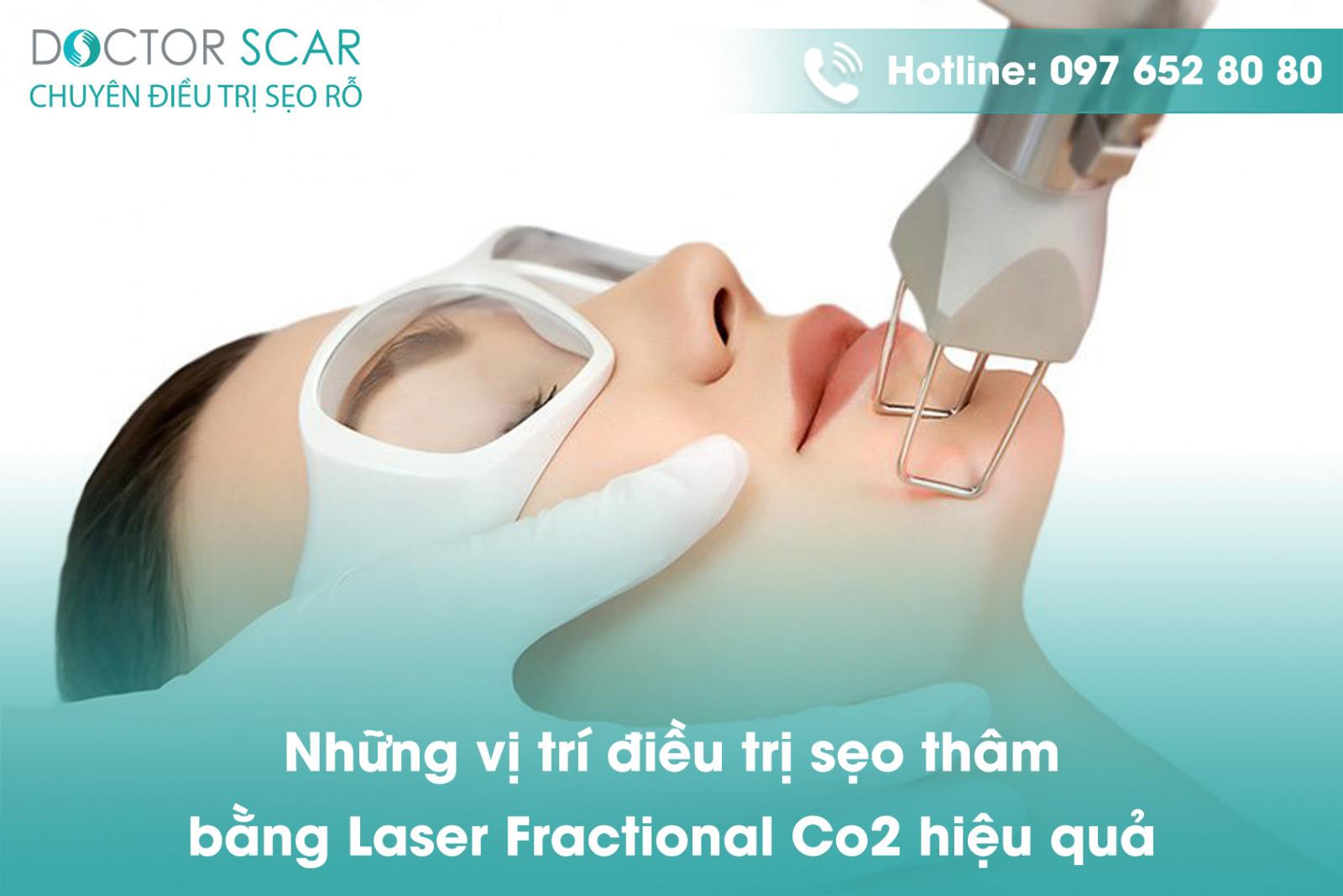 Những vị trí điều trị sẹo thâm bằng Laser Fractional CO2 hiệu quả