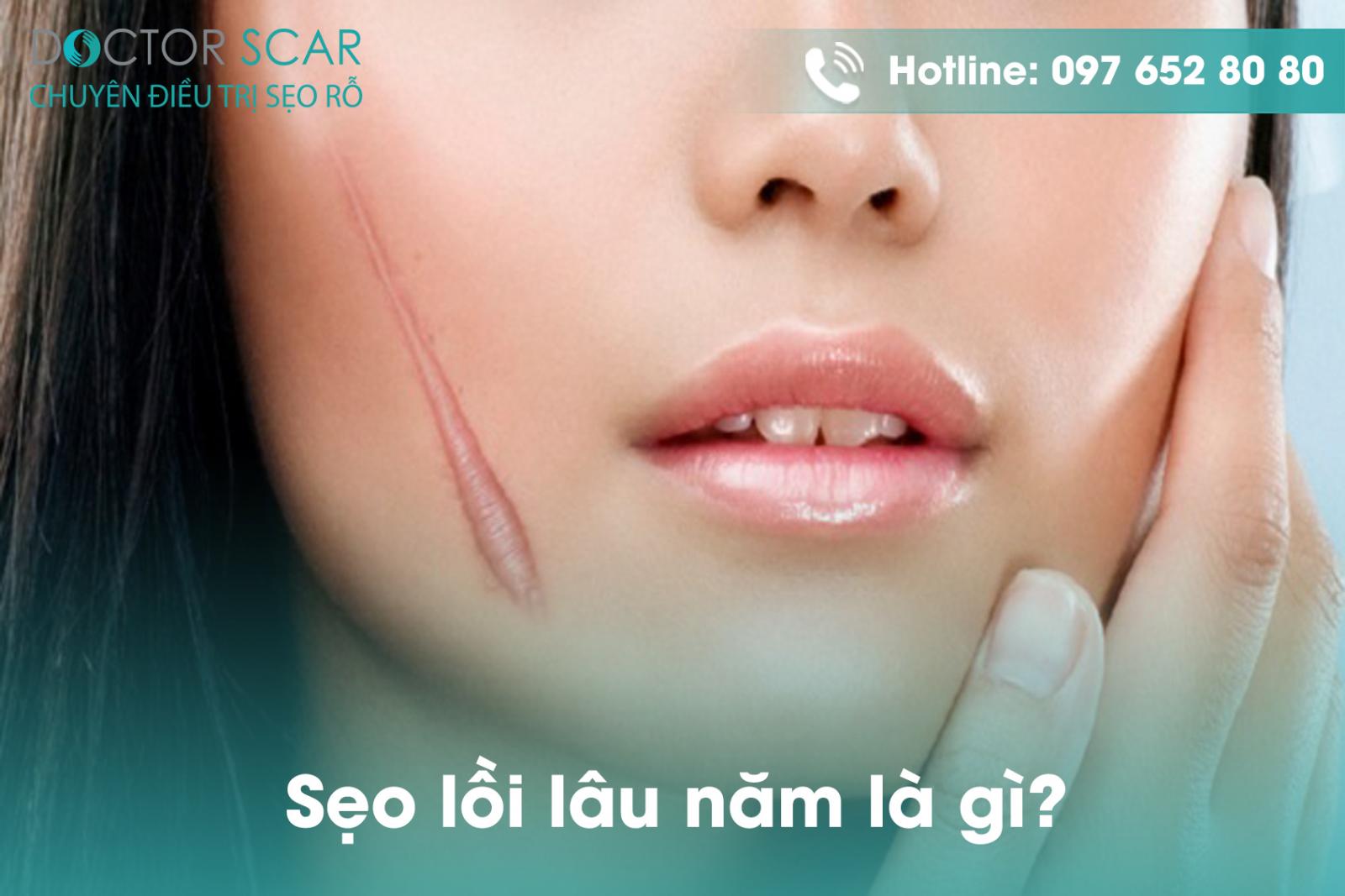 Sẹo lồi lâu năm là gì?