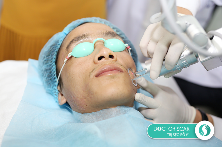 sẹo rỗ lâu năm có trị được không