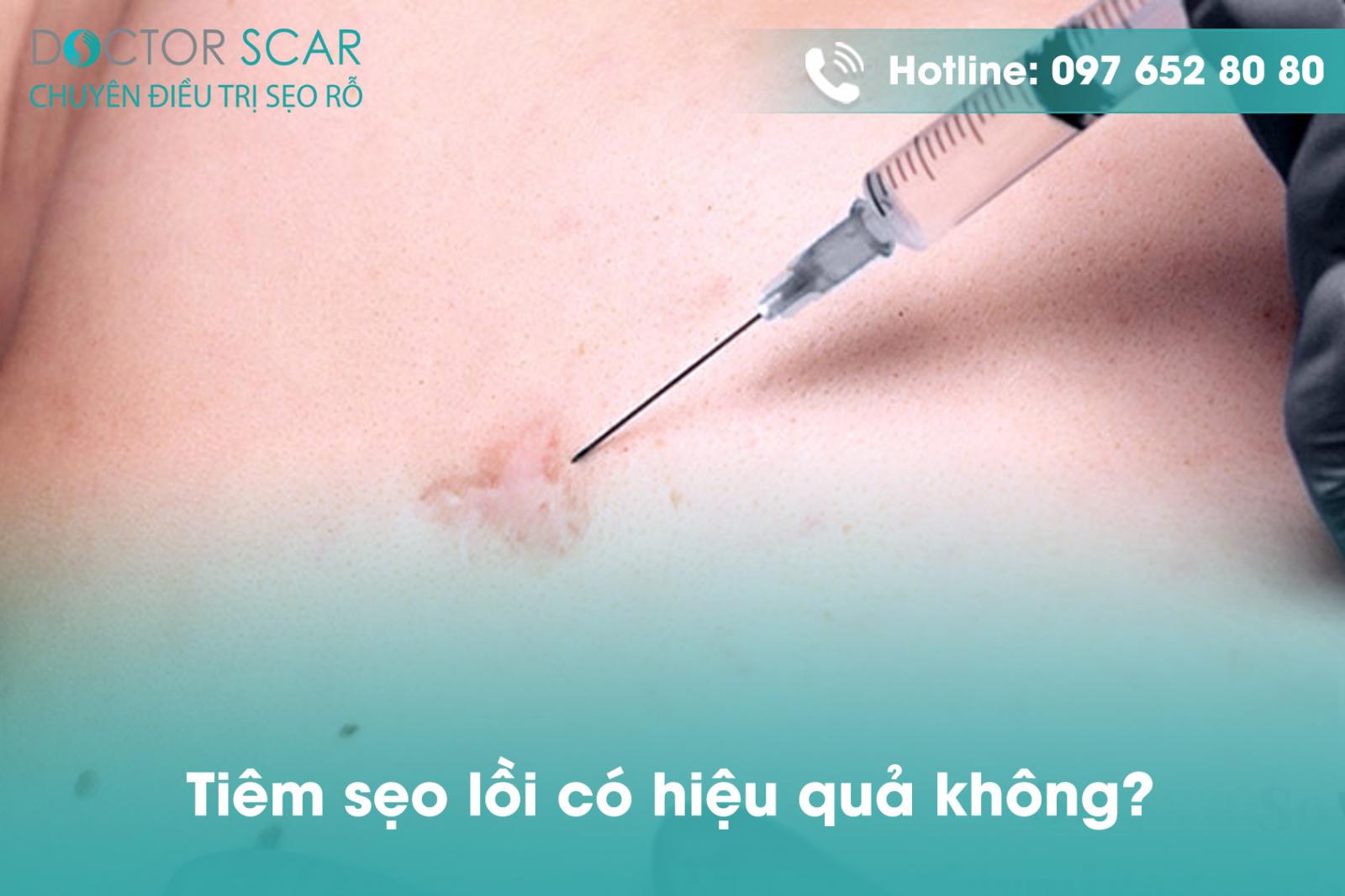 Tiêm sẹo lồi có hiệu quả không?