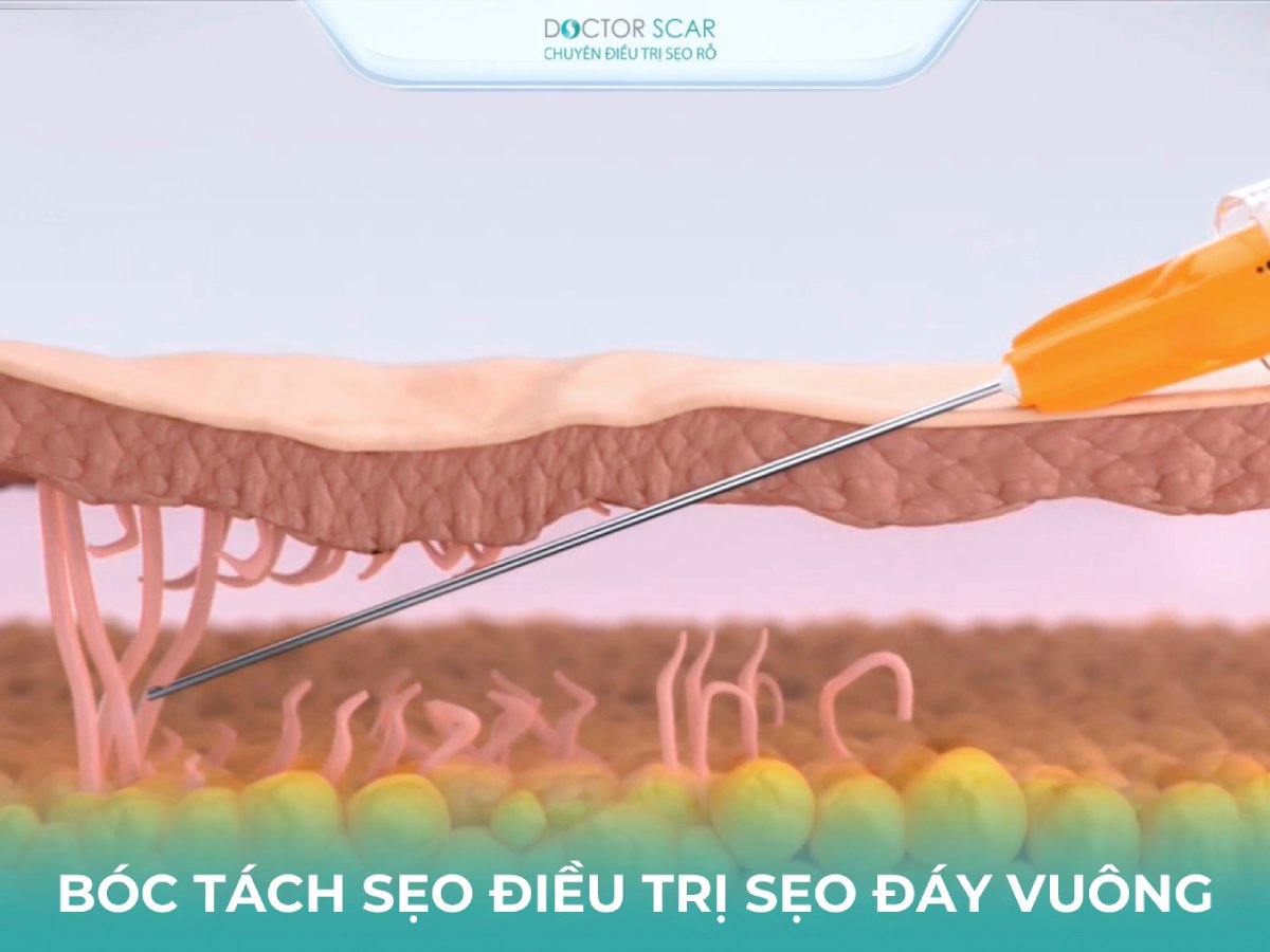 Trị sẹo rỗ đáy vuông bằng phương pháp bóc tách sẹo