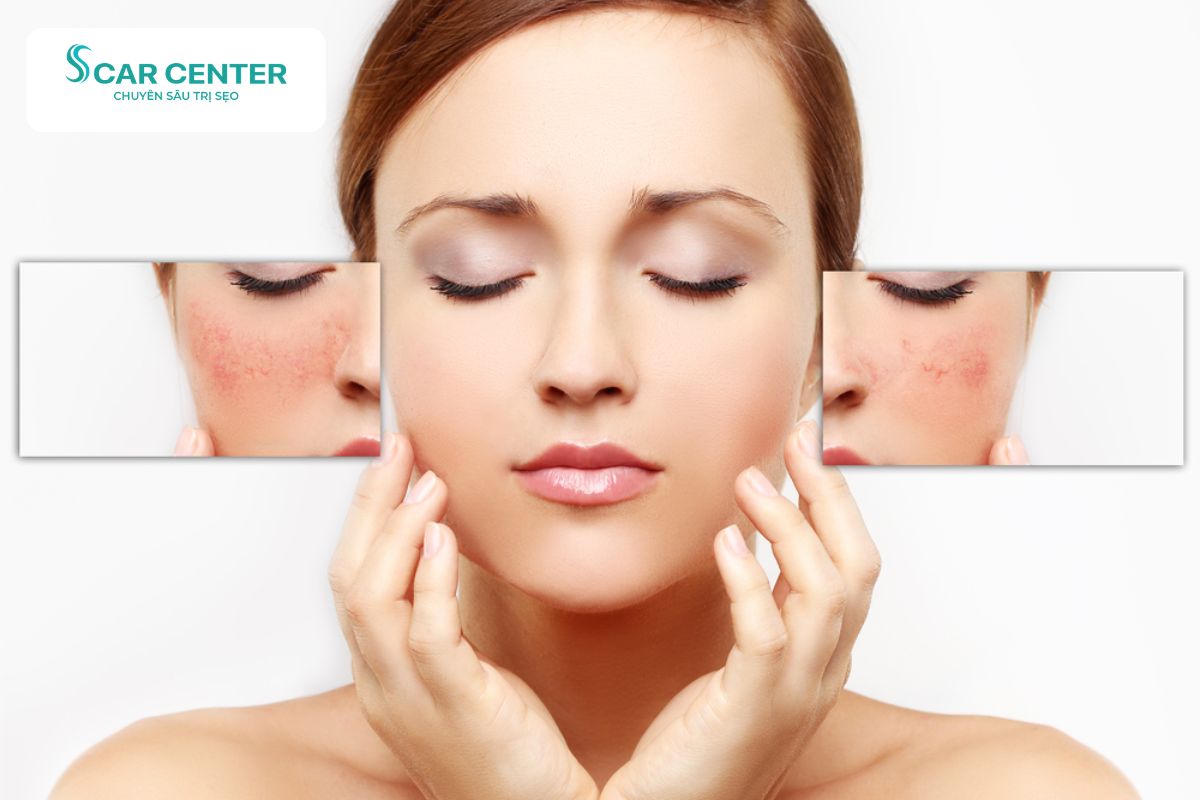 Chăm sóc da là bước quan trọng hỗ trợ quá trình phục hồi sau trị sẹo