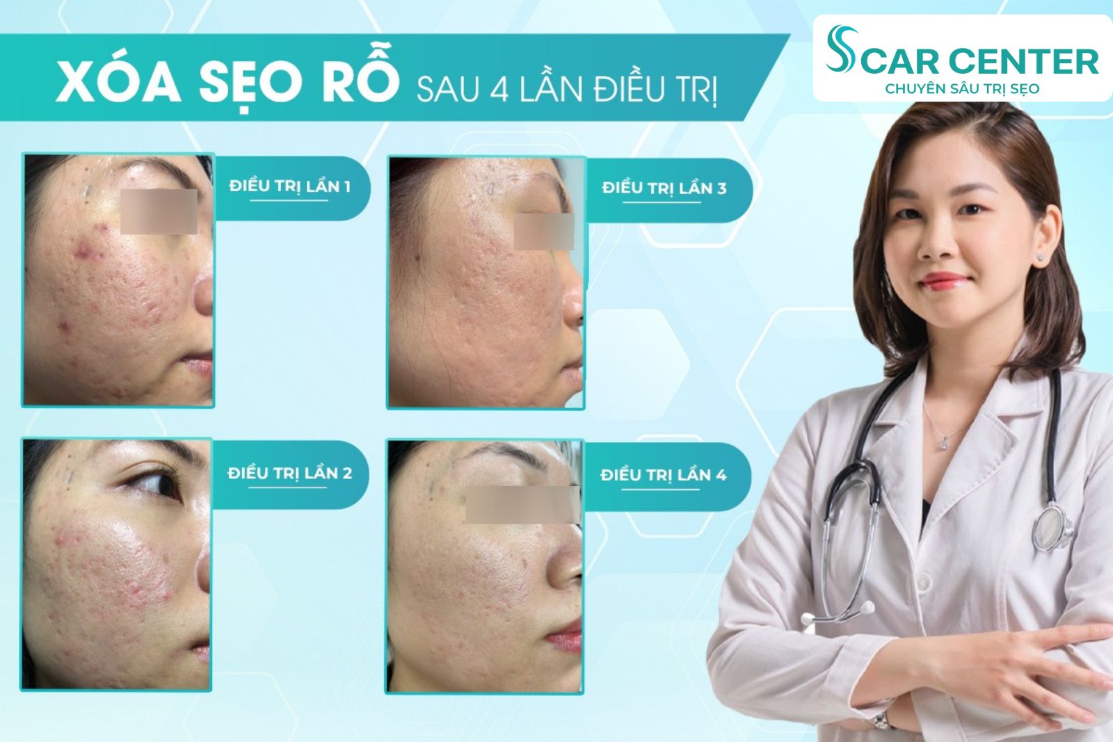 Công nghệ laser CO2 Fractional trị sẹo rỗ hiện đại cải thiện làn da rõ rệt