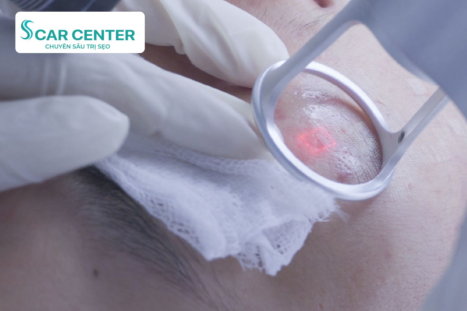 Công nghệ Laser Fractional CO2 trị sẹo lõm tại Scar Center