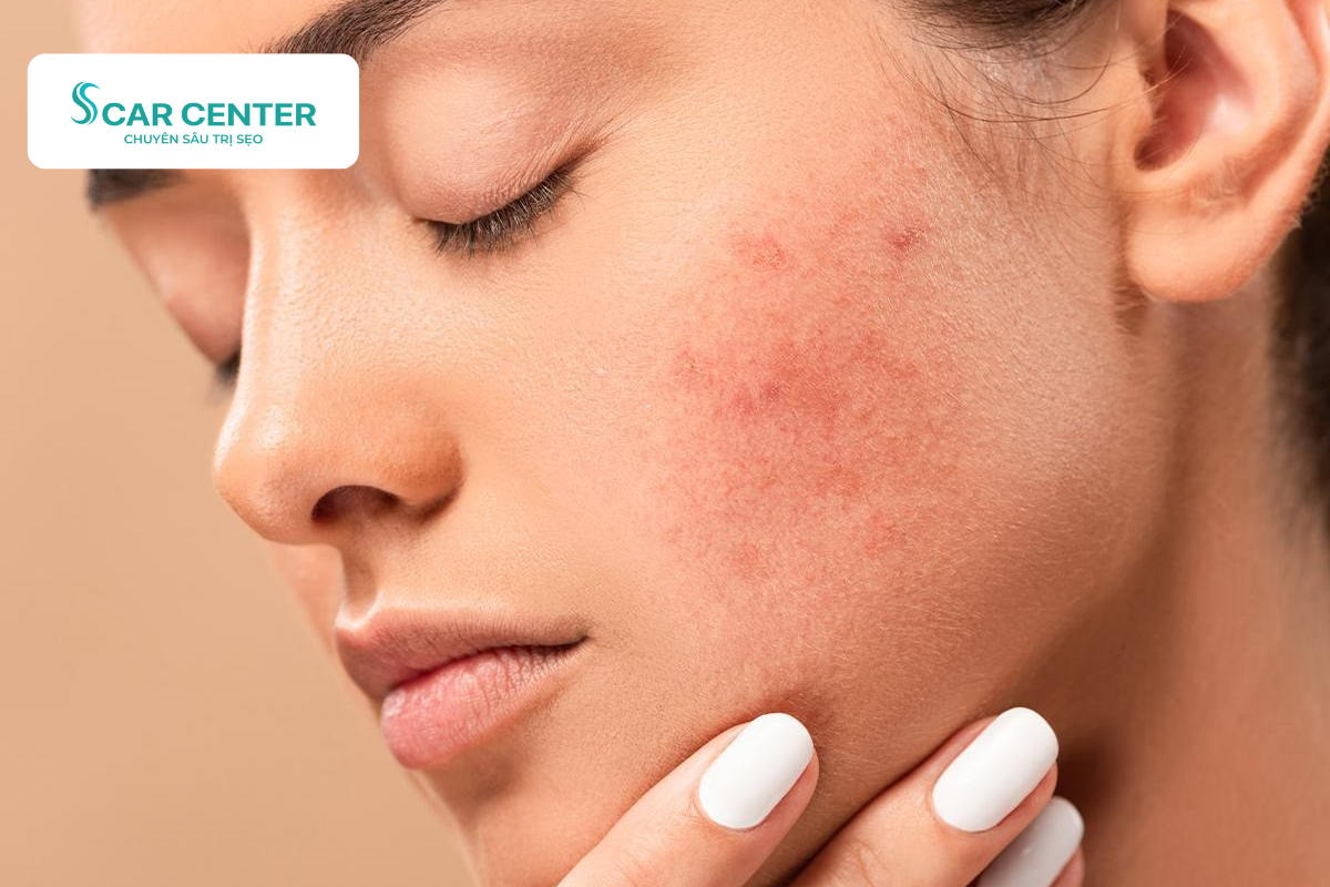 Da đỏ, rát sau khi điều trị bằng Laser Fractional CO2