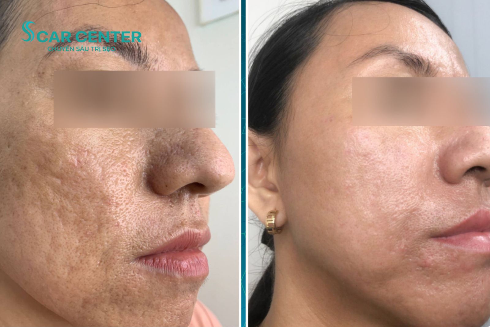 Fractional CO2 giúp làn da bị sẹo lõm nặng cải thiện đáng kể