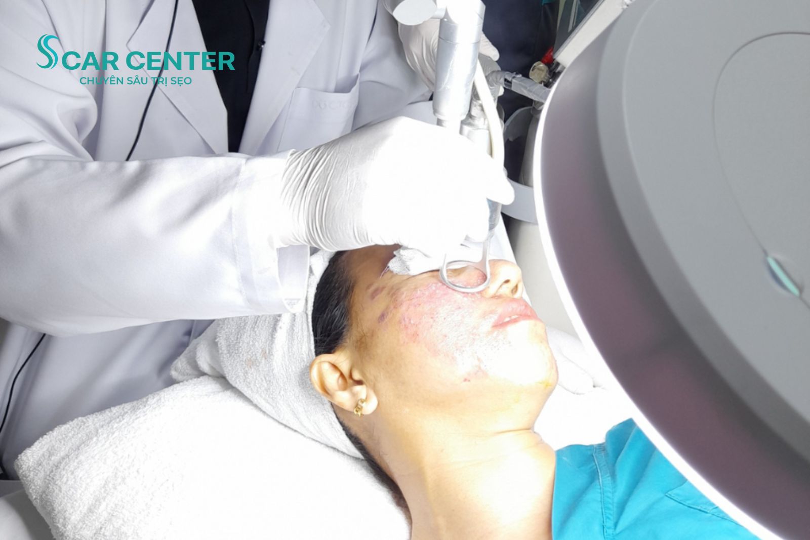 Giải mã công nghệ laser Fractional CO2