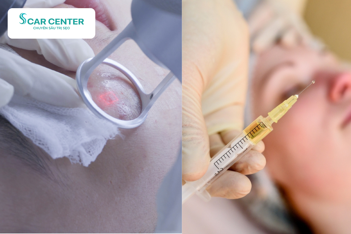 Kết hợp Fractional CO2 cùng phương pháp PRP