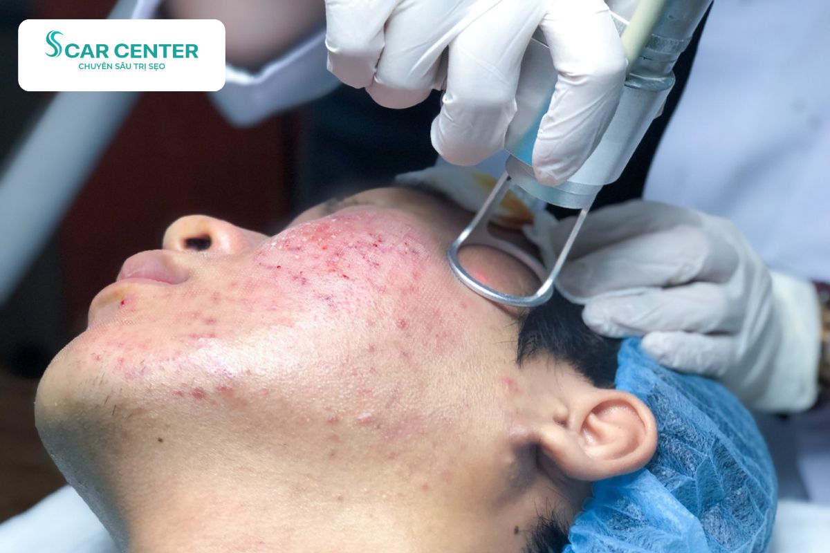 Công nghệ Laser Fractional CO2 được ứng dụng rộng rãi trong điều trị sẹo rỗ lâu năm