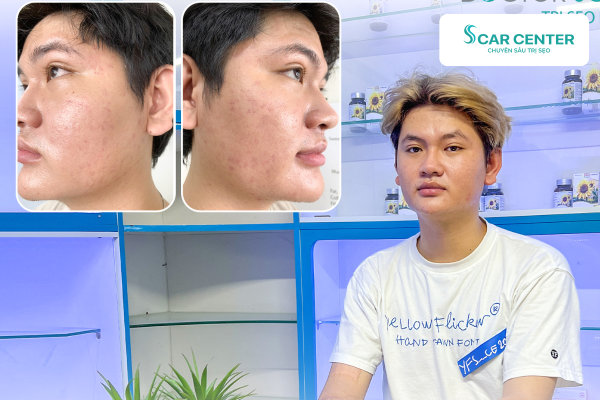 Laser Fractional CO2 là công nghệ “2 trong 1”