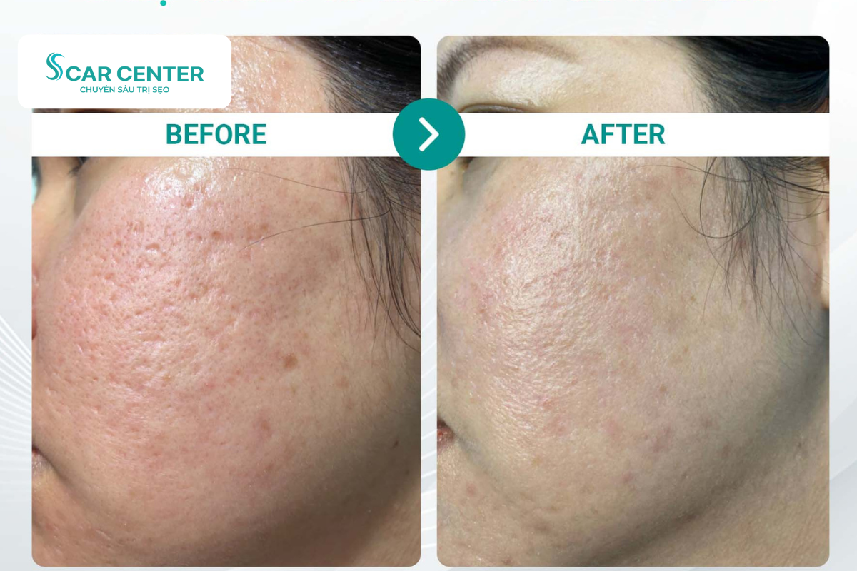 Laser Fractional CO2 trị sẹo lõm cải thiện ít nhất 70% sau một liệu trình