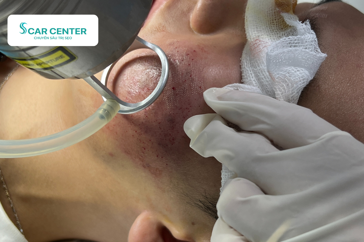 Laser Fractional CO2 trị sẹo lõm trên má cải thiện sau 1-2 buổi điều trị