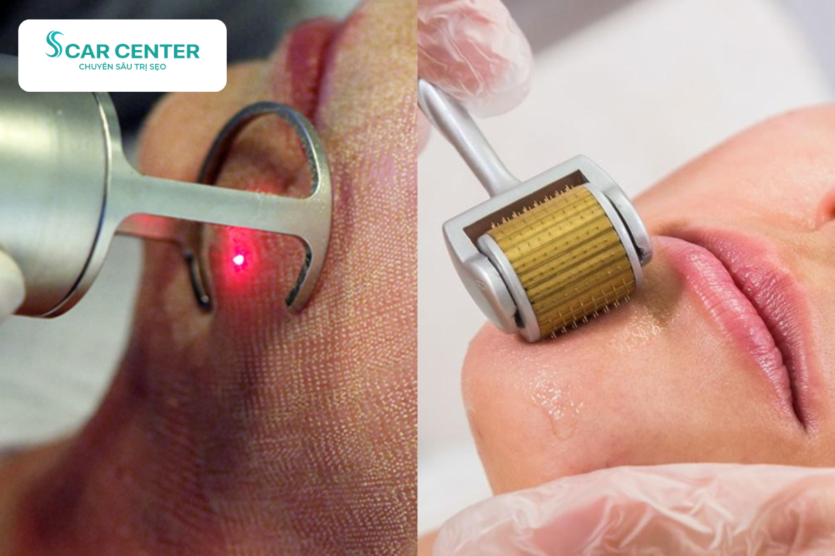 Laser Fractional CO2 trị sẹo rỗ kết hợp lăn kim tái tạo da chuyên sâu