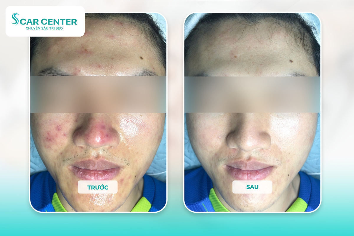Lấy lại làn da đẹp sau vài lần điều trị