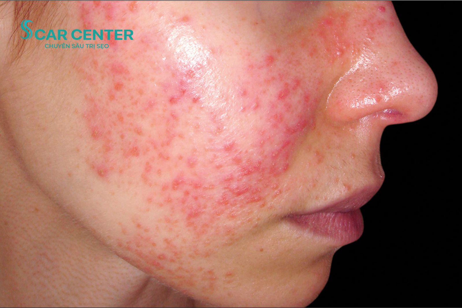 Một số trường hợp không nên áp dụng công nghệ laser CO2 Fractional