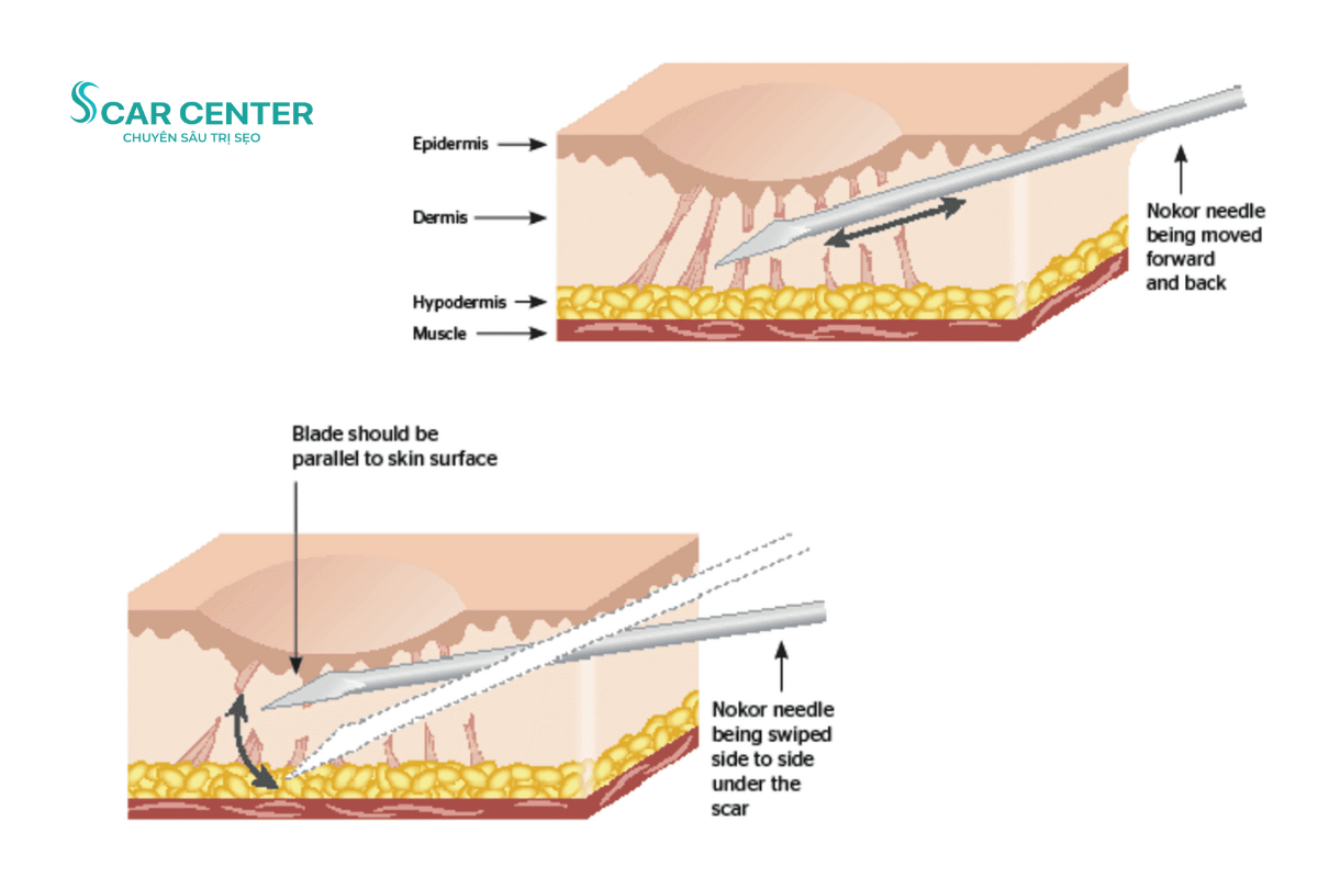 Nhiều người áp dụng phương pháp Subcision (cắt đáy sẹo) để trị sẹo rỗ lâu năm