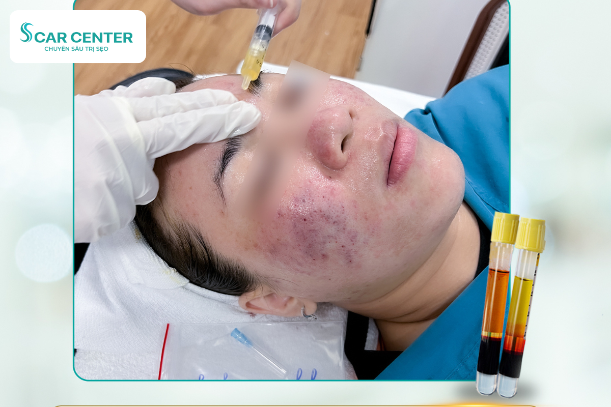 PRP (Platelet Rich Plasma) – Hồi phục và nuôi dưỡng