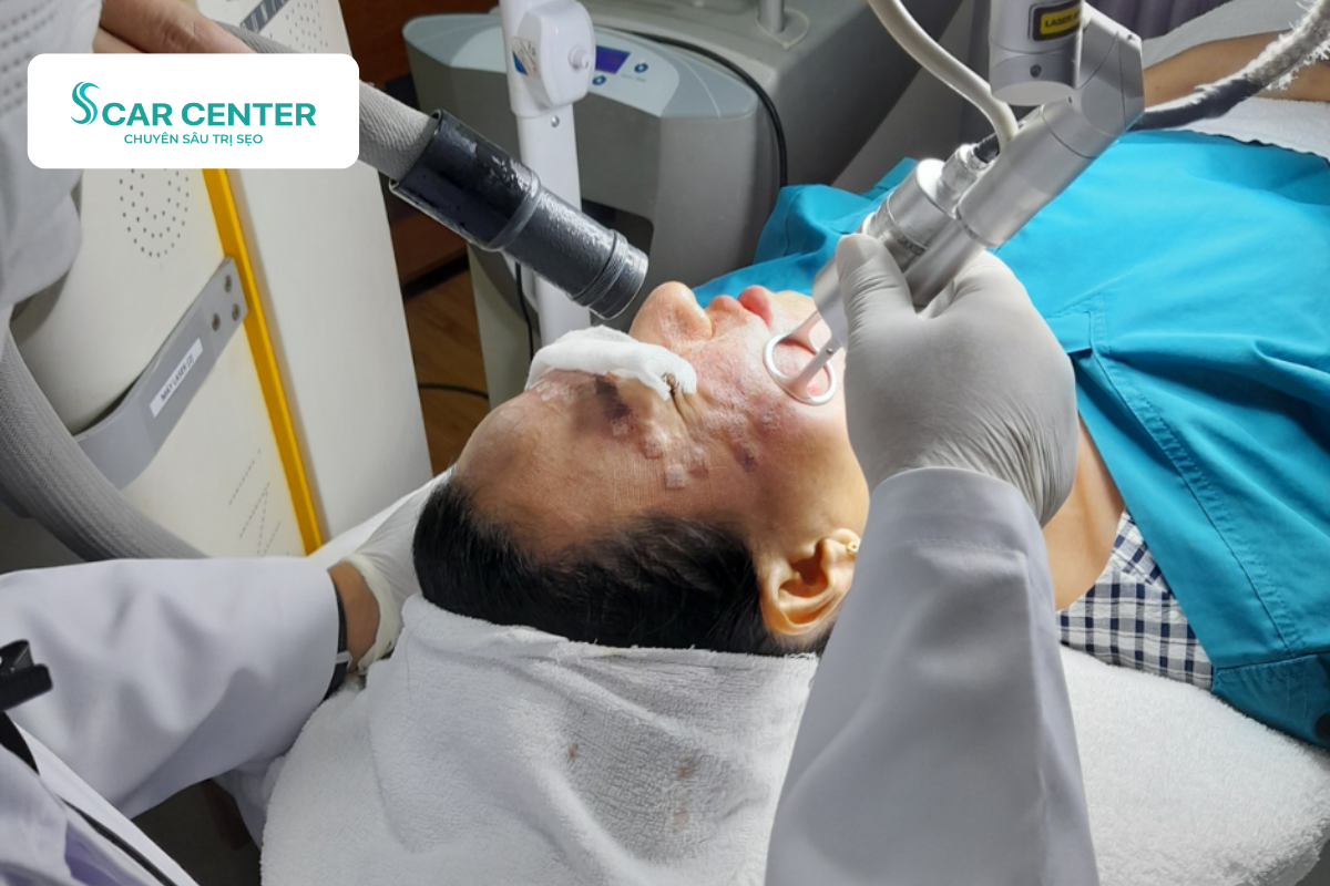 Scar Center ứng dụng Fractional CO2 trị sẹo rỗ cho nữ