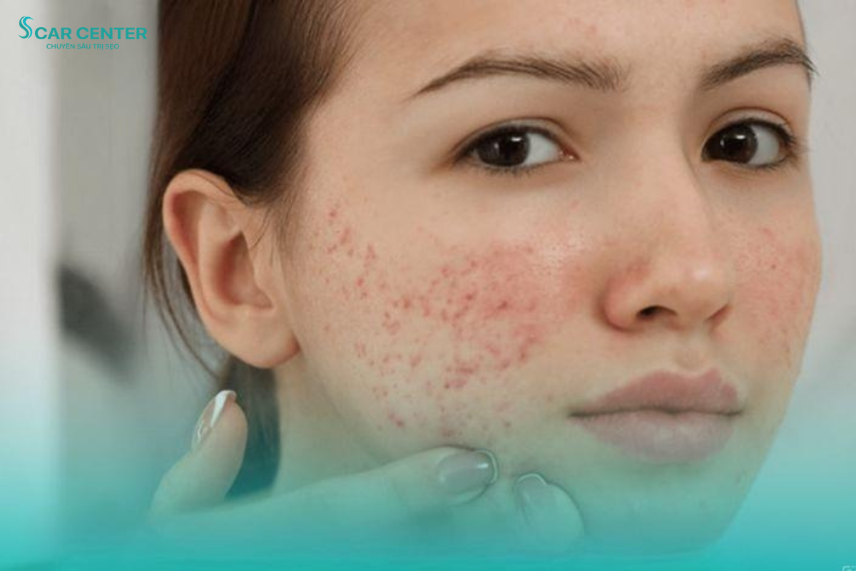 điều trị mụn trước khi trị sẹo