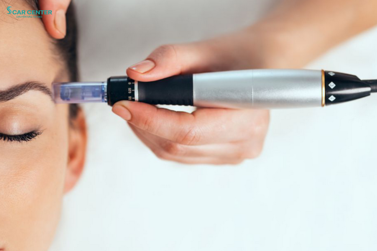 Meso không xâm lấn